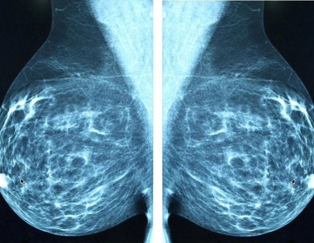 Liquid biopsy predicts immune response in high-risk breast cancer patients